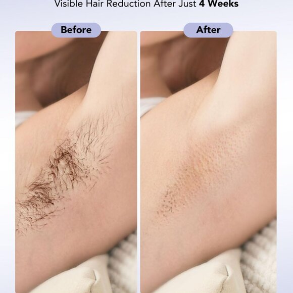 SKG Laser Hair Removal Device Painless IPL Infinite Flashes Dual-Pulse T033MW - Picture 2 of 9